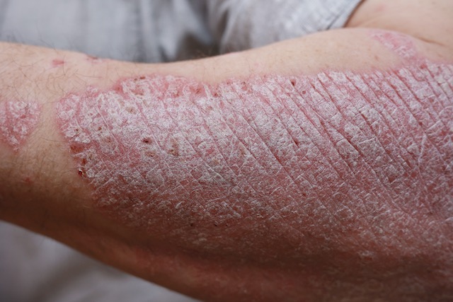 Psoriasis, an autoimmune Ski condition disorder